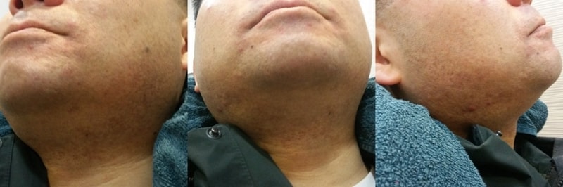 수염후.jpg