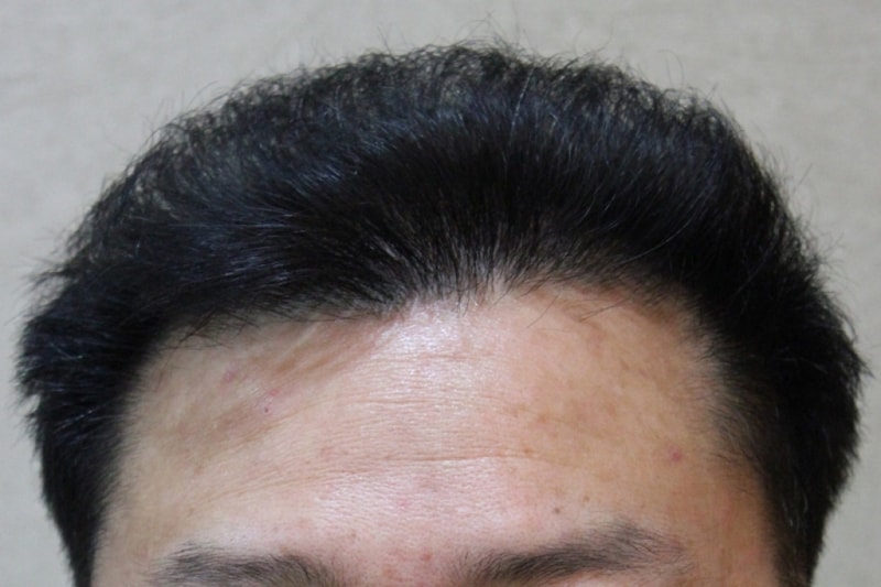 수술후(1).JPG