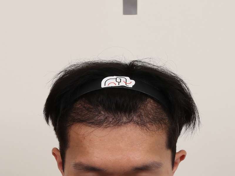 Busan Hair Transplantation Slit Method Mamos M-shape + Retrofit after 4 months