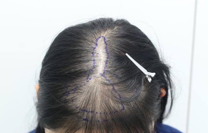 在狎鸥亭Mammos Hairine医院接受毛发移植10个月后后期（现在是1年以上）