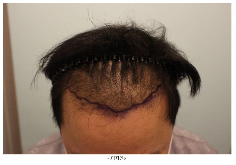 수술전.JPG