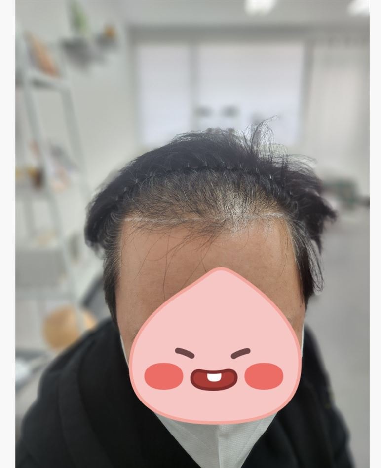 머리이식.JPG