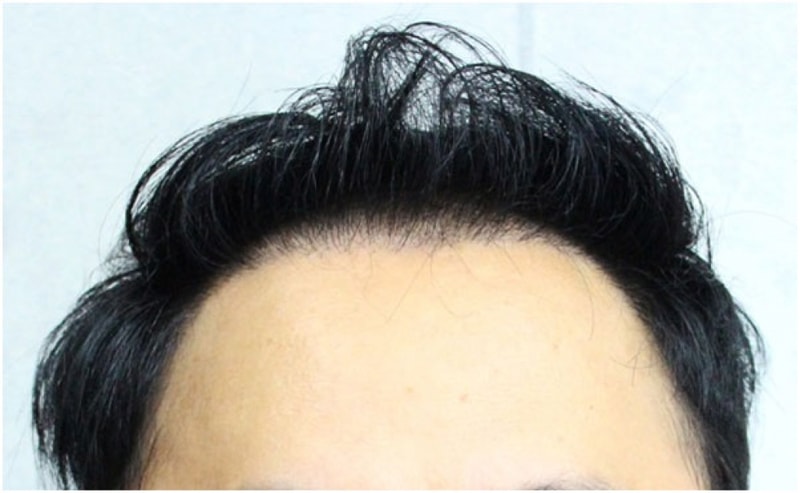 수술후.jpg
