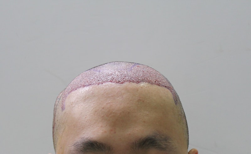 수술직후 1 편집.jpg