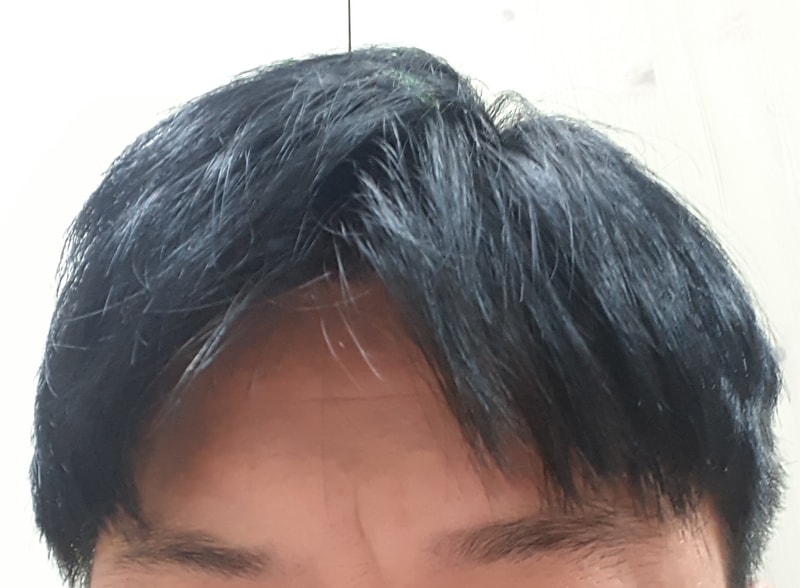 Hair transplant 2 years and 2 months