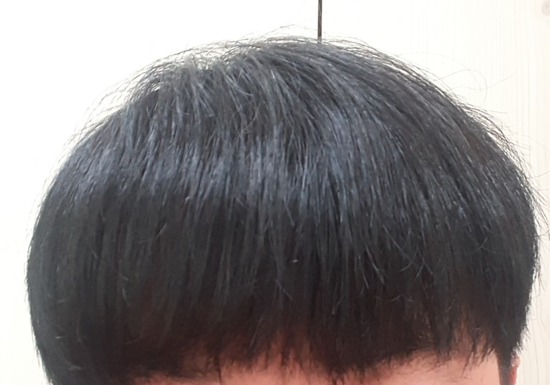 It's been two years and 10 months since the hair transplant.
