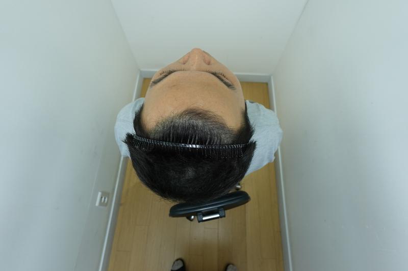 자라다의원 수술후120일차 후기