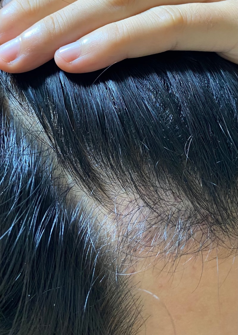 3rd Month of Non-Cutting Transplantation