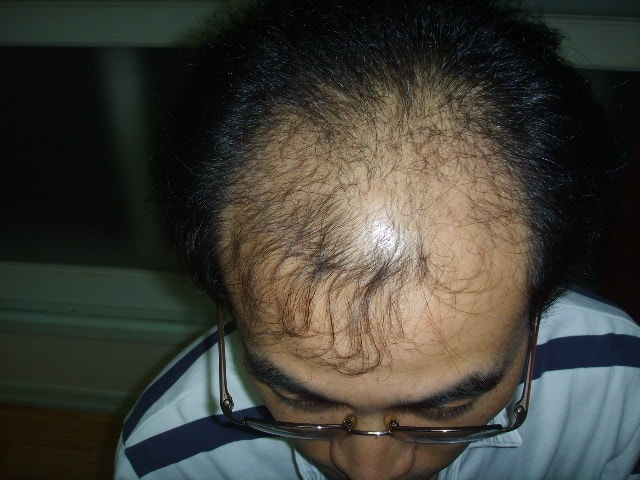 수술하기전.JPG