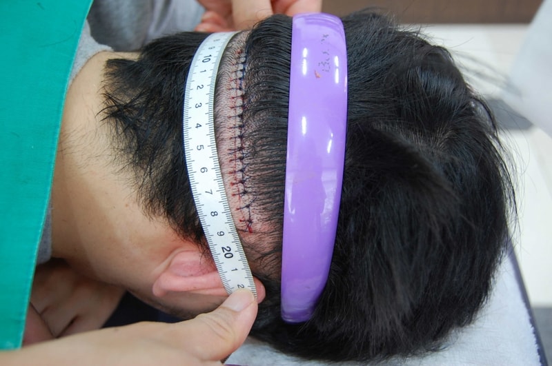 釜山韩相宝医院2831顶移植后~！