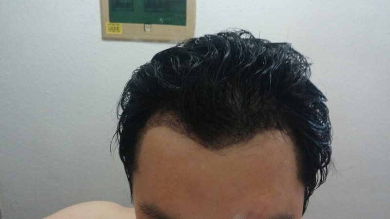 It is the first week of non-cut 2500 hair transplantation.