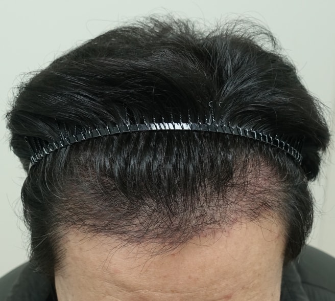 1. 이마 위.jpg