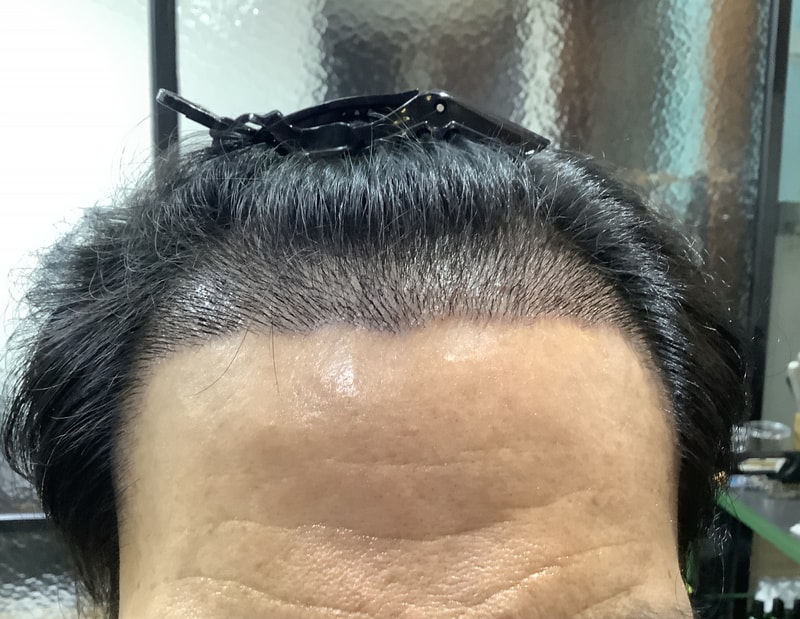 [자라다의원] 비절개 3000모낭 4개월차 후기