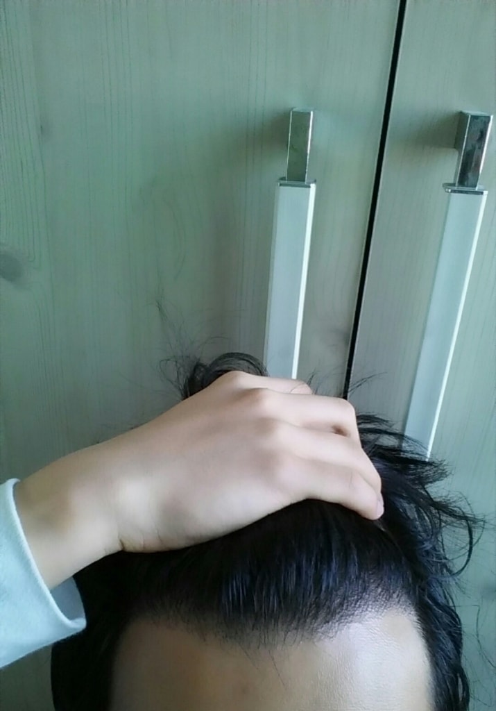 FOHAIR M字800毛囊移植第11个月后期
