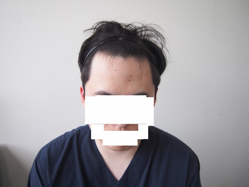 毛在成整形外科毛发移植 4 个月后期