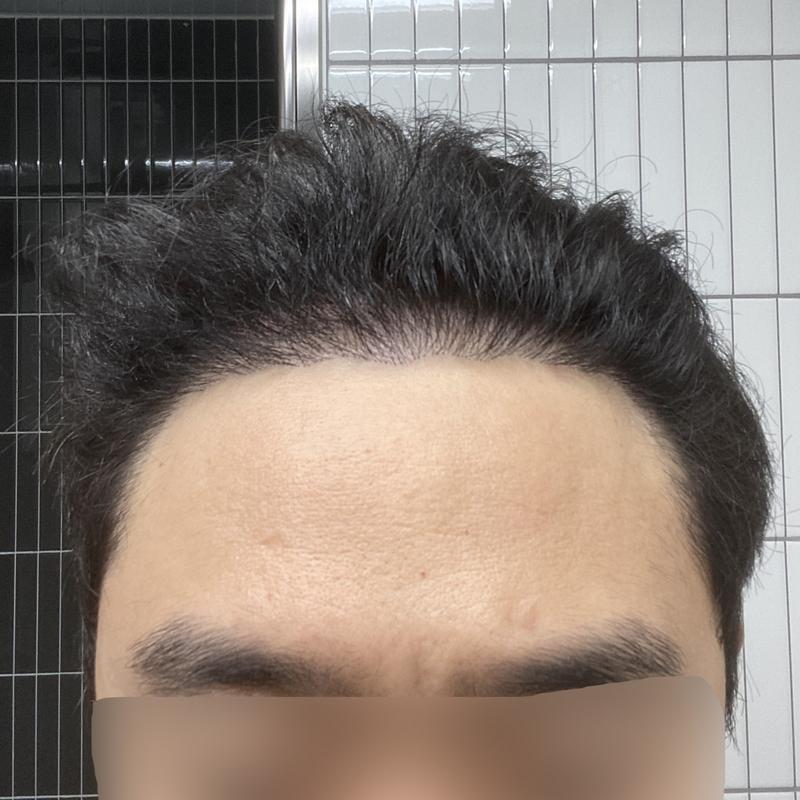 밀도 보강 9개월 차 후기입니다.