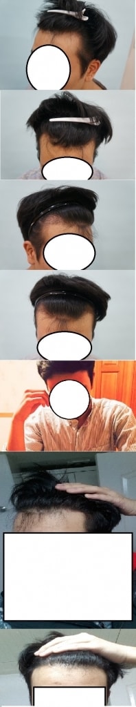m자 비절개 모발이식 9개월 후기에요~
