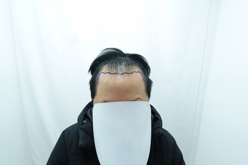 14일차 딱지 제거 샴푸