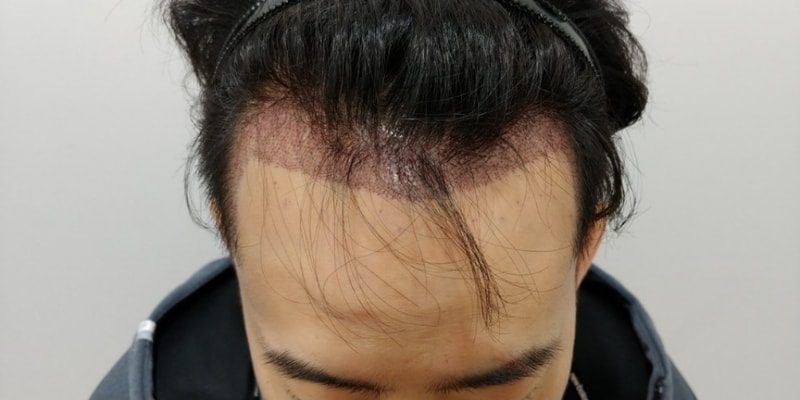 수술후.jpg