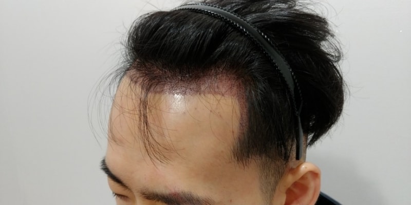 수술후2.jpg