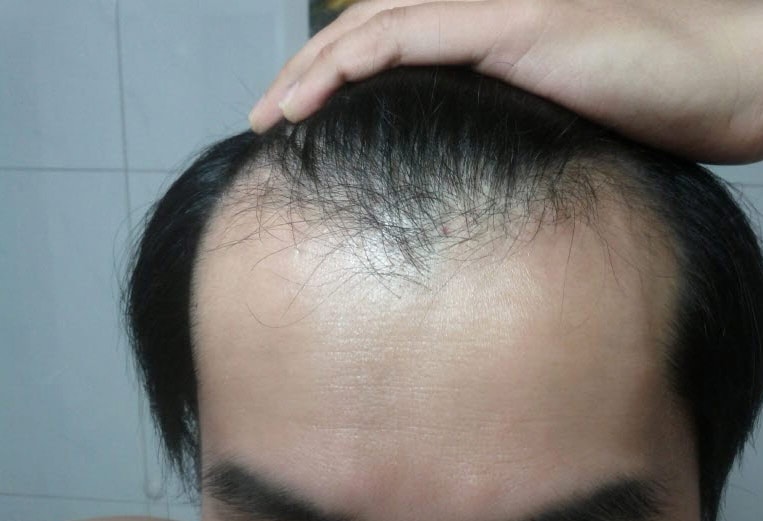 앞이마1.jpg