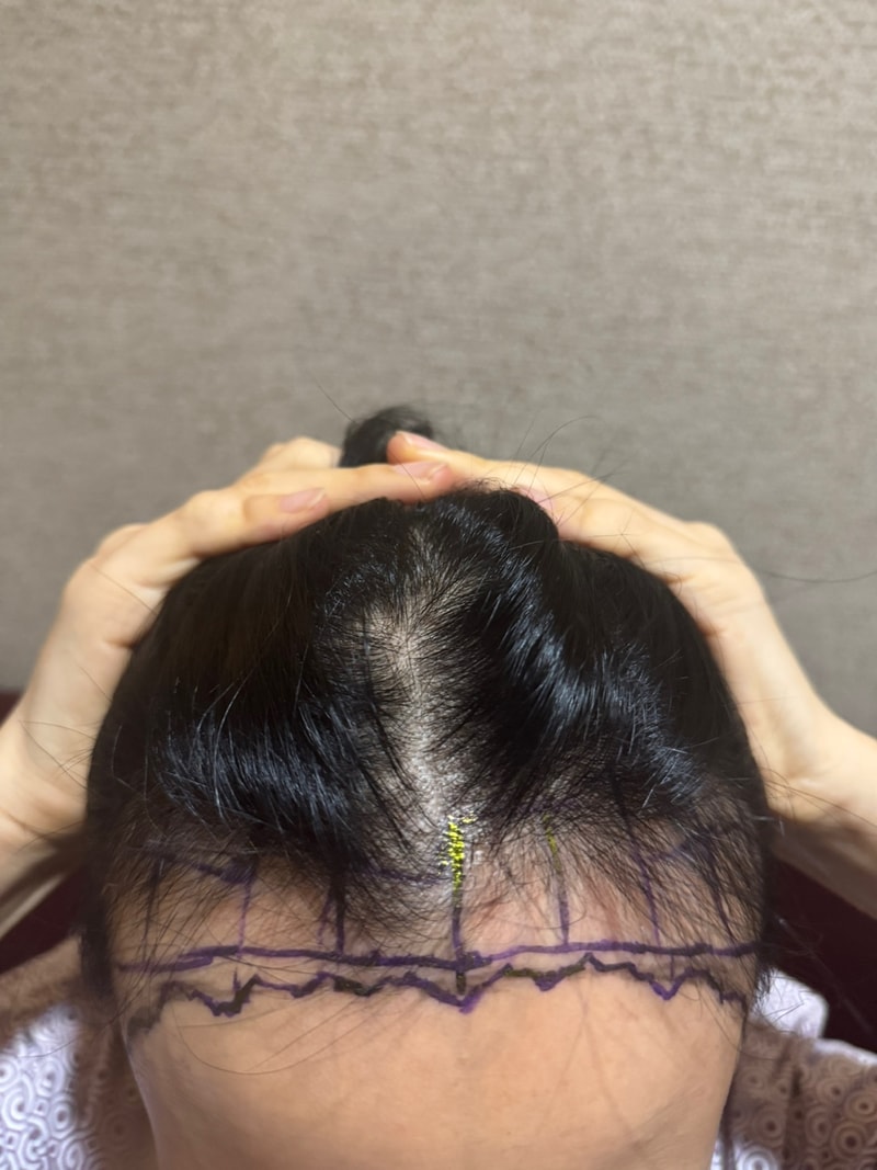 I had a hairline transplant