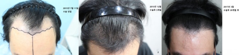 수술후 20개월 경과 사진 입니다.