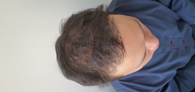 Parental 2000 Hair follicles Day 3