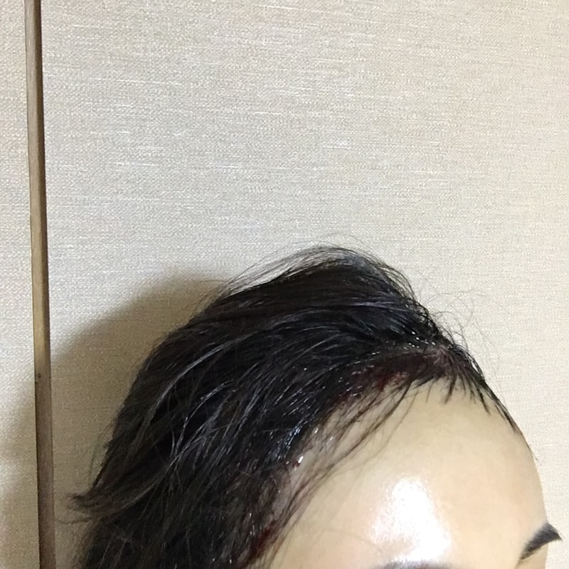 왼쪽당일.jpg