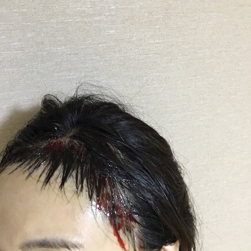 오른쪽당일.jpg
