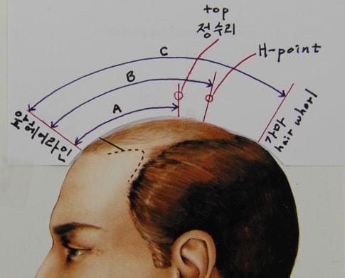 Busan Korean Complementary Transplantation Center - Transplantation Plan for U-type Hair Loss