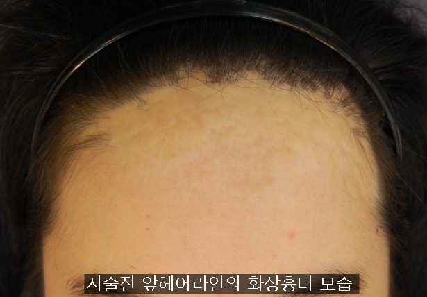 Case of Transplantation of Severe Burn Scars - 1 <Busan Han Sang-bo Hair Transplantation Center>