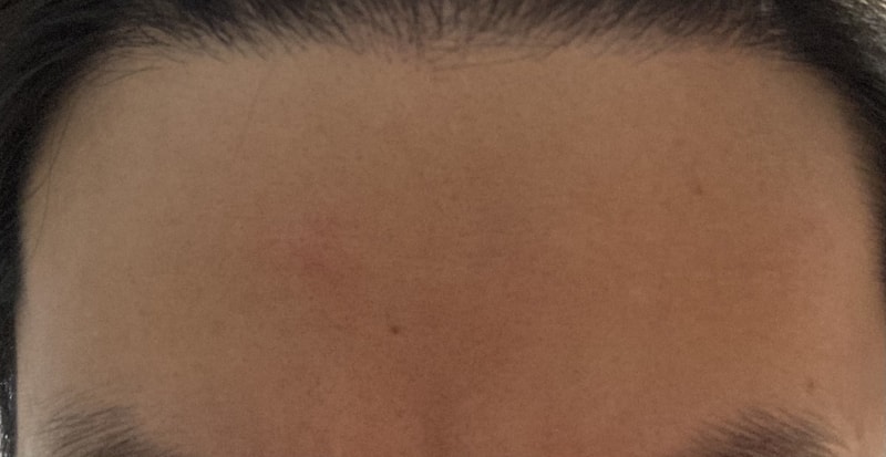 Hairline 911 Hair follicle 1st Year Review