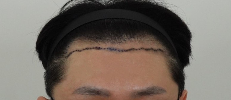 아들 M자탈모, 용닥터 비절개모발이식 3200모 1년 후기 – 이 정도면 아이돌 데뷔각인가요 ㅋㅋ
