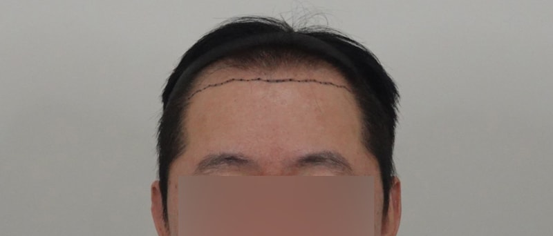 용닥터의원에서 모발이식 받고 1년이 지났습니다.