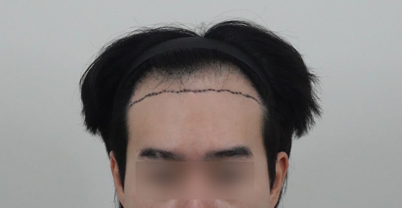 모발이식 7개월차, M자 탈모 4500모 받고 느낌 변화