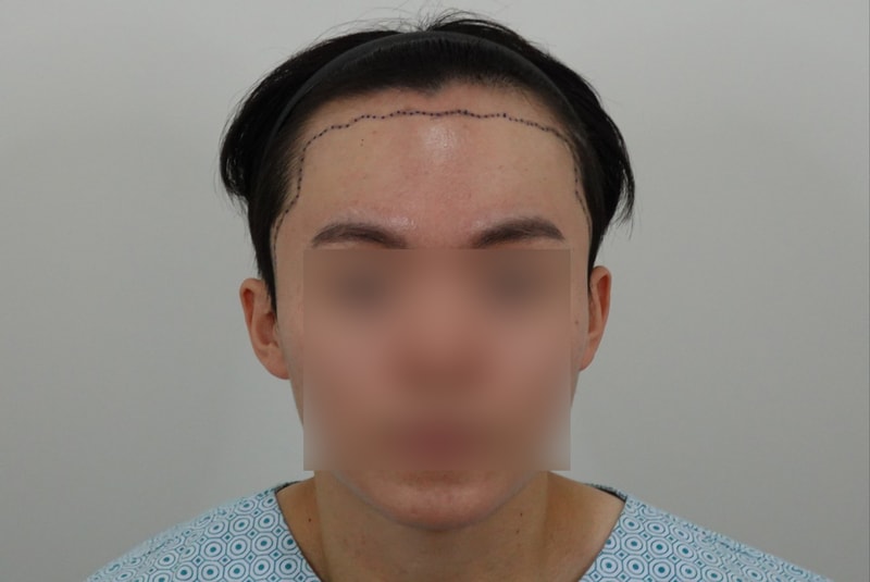 1st Year of Non-Cutting 2000 Hair Transplantation