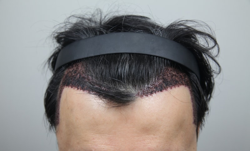 수술후정면.JPG