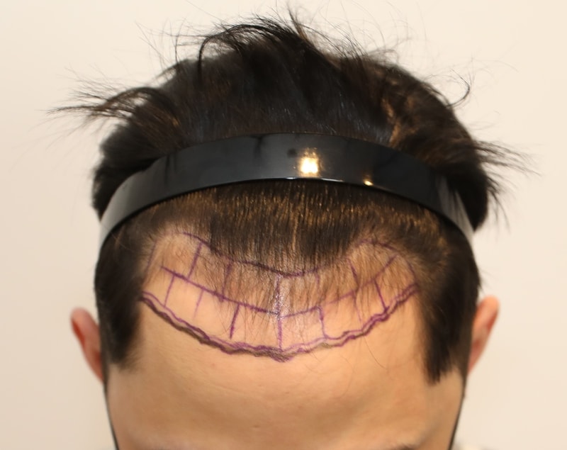 ニューヘア毛髪整形外科1年目レビュー (切開毛髪移植4300毛)