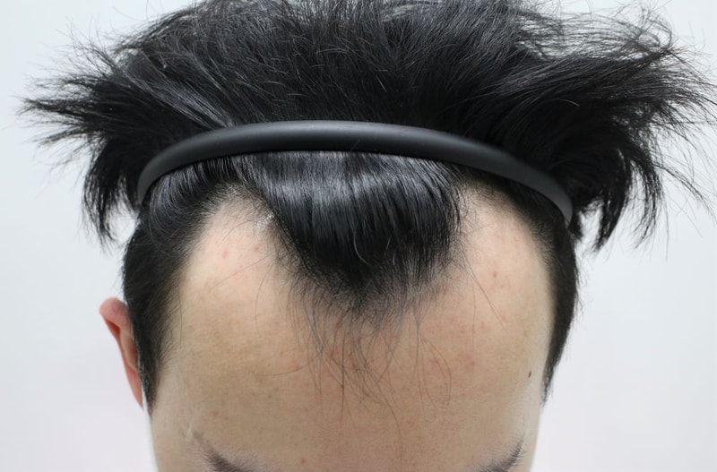 It's different Daegu Pohair M-shape for 7 months (Director Jang Sung-ho)
