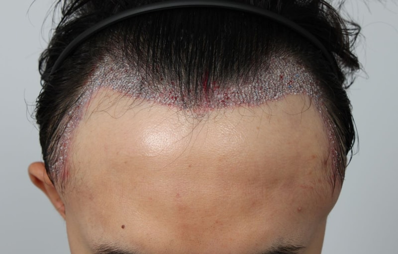 03.이식당일.JPG