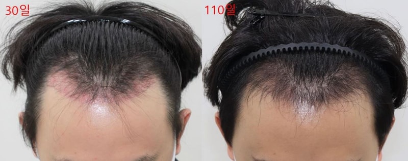 大邱ポヘア暗黒期脱出過程 非切開 M者 チャン·ソンホ院長