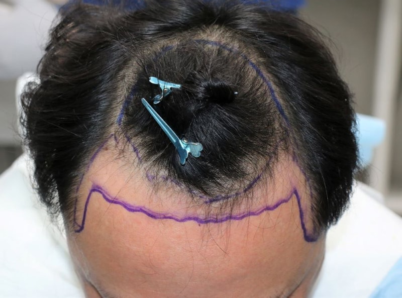 Pohair non-cut hair transplant 2000 hair follicles 6 months late