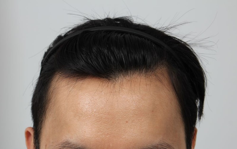 Are you lucky to pass the Busan Four Hair M-shape non-cut hair transplant without a dark age?Hahaha after 50 days