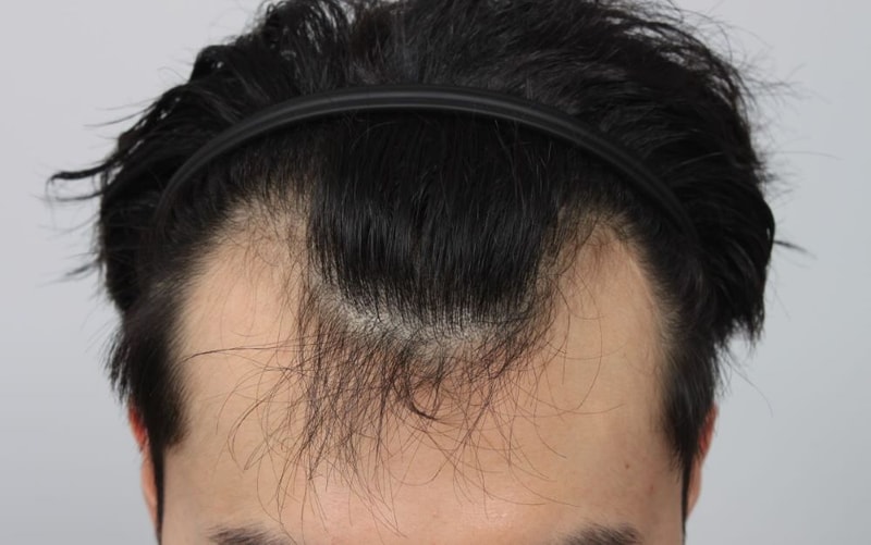 最も価値のある投資···釜山ポヘア毛髪移植255日(パク·サンゴン院長)