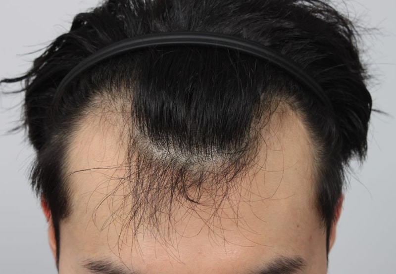 釜山ポヘアU字型脱毛症 非切開毛髪移植 1年変化後のレビュー