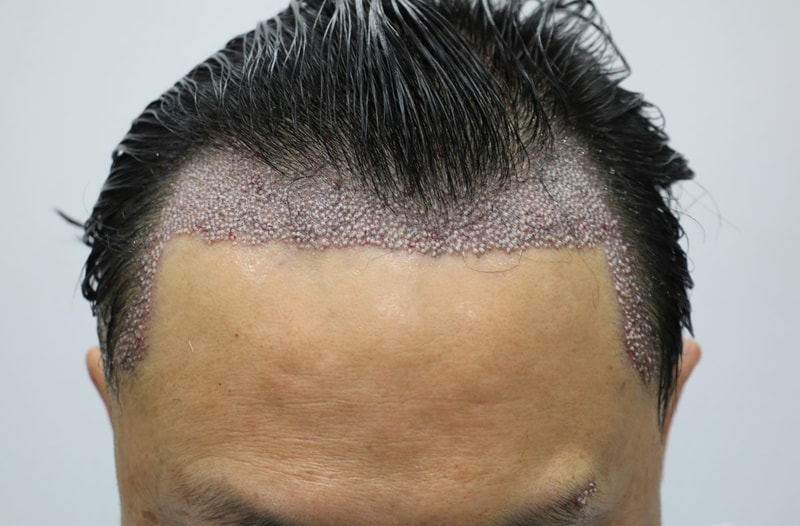 04.수술당일.JPG