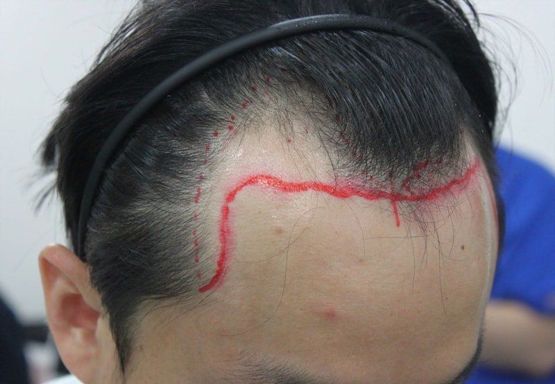 釜山非切开毛发移植 For Hair M字经过6个月