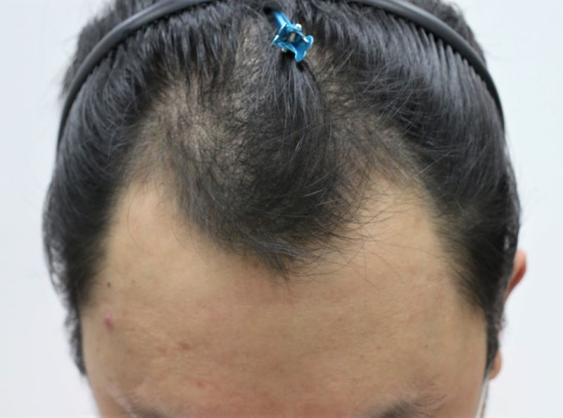 大邱FOR HAIR院长张成浩的EMZA非切开部分削发4个月后期