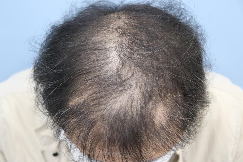 One year after hair transplantation